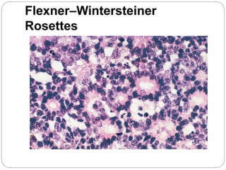 Flexner–Wintersteiner
Rosettes
 