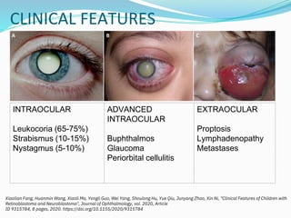 CLINICAL FEATURES
Xiaolian Fang, Huanmin Wang, Xiaoli Ma, Yongli Guo, Wei Yang, Shoulong Hu, Yue Qiu, Junyang Zhao, Xin Ni, "Clinical Features of Children with
Retinoblastoma and Neuroblastoma", Journal of Ophthalmology, vol. 2020, Article
ID 9315784, 8 pages, 2020. https://doi.org/10.1155/2020/9315784
INTRAOCULAR
Leukocoria (65-75%)
Strabismus (10-15%)
Nystagmus (5-10%)
ADVANCED
INTRAOCULAR
Buphthalmos
Glaucoma
Periorbital cellulitis
EXTRAOCULAR
Proptosis
Lymphadenopathy
Metastases
 
