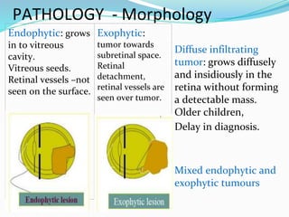 Endophytic: grows
in to vitreous
cavity.
Vitreous seeds.
Retinal vessels –not
seen on the surface.
Exophytic:
tumor towards
subretinal space.
Retinal
detachment,
retinal vessels are
seen over tumor.
Diffuse infiltrating
tumor: grows diffusely
and insidiously in the
retina without forming
a detectable mass.
Older children,
Delay in diagnosis.
Mixed endophytic and
exophytic tumours
PATHOLOGY - Morphology
 