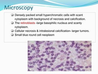 Microscopy
 Densely packed small hyperchromatic cells with scant
cytoplasm with background of necrosis and calcification.
 The retinoblasts -large basophilic nucleus and scanty
cytoplasm.
 Cellular necrosis & intralesional calcification- larger tumors.
 Small blue round cell neoplasm
 