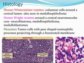 Histology
Flexner Wintersteiner rosettes -columnar cells around a
central lumen -also seen in medulloepithelioma
Homer Wright rosettes around a central neuromuscular
core -neuroblastoma, medulloepithelioma,
medulloblastomas
Fleurettes Tumor cells with pear shaped eosinophilic
processes projecting through a fenestrated membrane
 