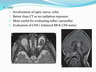 6) MRI
⮚ Involvement of optic nerve, orbit
⮚ Better than CT as no radiation exposure
⮚ Most useful for evaluating sellar/ parasellar
⮚ Evaluation of CNS ( trilateral RB & CNS mets)
 