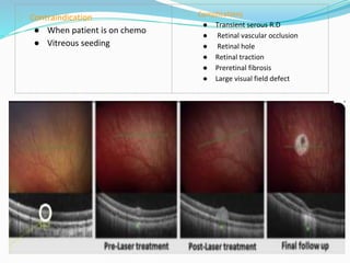 ⮚ Contraindication
● When patient is on chemo
● Vitreous seeding
⮚ Complications
● Transient serous R.D
● Retinal vascular occlusion
● Retinal hole
● Retinal traction
● Preretinal fibrosis
● Large visual field defect
 