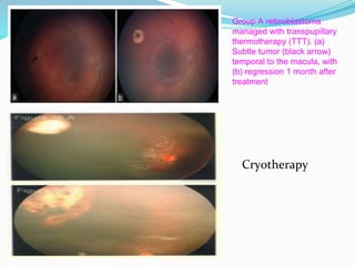Group A retinoblastoma
managed with transpupillary
thermotherapy (TTT). (a)
Subtle tumor (black arrow)
temporal to the macula, with
(b) regression 1 month after
treatment
Cryotherapy
 