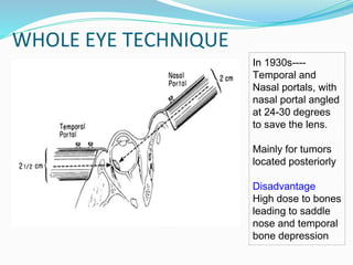 WHOLE EYE TECHNIQUE
In 1930s----
Temporal and
Nasal portals, with
nasal portal angled
at 24-30 degrees
to save the lens.
Mainly for tumors
located posteriorly
Disadvantage
High dose to bones
leading to saddle
nose and temporal
bone depression
 