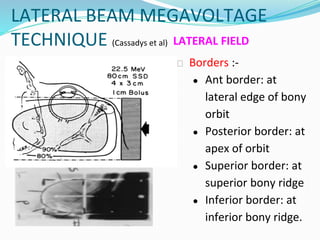 LATERAL BEAM MEGAVOLTAGE
TECHNIQUE (Cassadys et al) LATERAL FIELD
⮚ Borders :-
● Ant border: at
lateral edge of bony
orbit
● Posterior border: at
apex of orbit
● Superior border: at
superior bony ridge
● Inferior border: at
inferior bony ridge.
 