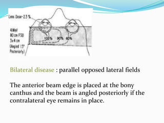 Bilateral disease : parallel opposed lateral fields
The anterior beam edge is placed at the bony
canthus and the beam is angled posteriorly if the
contralateral eye remains in place.
 