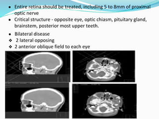 ● Bilateral disease
❖ 2 lateral opposing
❖ 2 anterior oblique field to each eye
● Entire retina should be treated, including 5 to 8mm of proximal
optic nerve
● Critical structure - opposite eye, optic chiasm, pituitary gland,
brainstem, posterior most upper teeth.
 