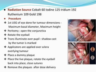 ● Radiation Source Cobalt 60 Iodine 125 Iridium 192
Ruthenium 109 Gold 198
● Procedure
❖ 1st USG of eye done for tumour dimensions -
Maximum basal diameter, Maximum height
❖ Peritomy : open the conjunctiva
❖ Rotate the eyeball
❖ Trans illuminate over pupil : shadow cast
by the tumor is marked
❖ Applicators are applied over sclera
overlying tumour
❖ Place a dummy plaque
❖ Place the live plaque, rotate the eyeball
back into place, close sutures
❖ Remove the plaques after dose delivery
 