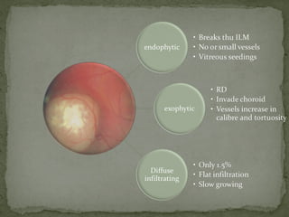 Retinoblastoma (Rb)
