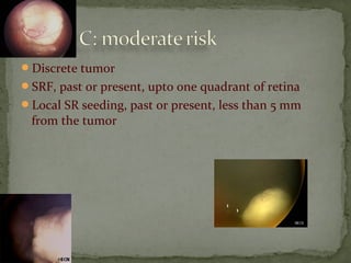 Discrete tumor
SRF, past or present, upto one quadrant of retina
Local SR seeding, past or present, less than 5 mm
from the tumor
 