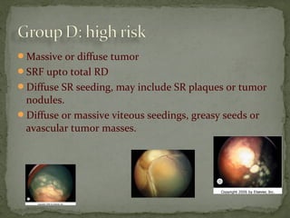 Massive or diffuse tumor
SRF upto total RD
Diffuse SR seeding, may include SR plaques or tumor
nodules.
Diffuse or massive viteous seedings, greasy seeds or
avascular tumor masses.
 