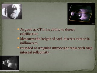 As good as CT in its ability to detect
calcification
Measures the height of each discrete tumor in
millimeters
rounded or irregular intraocular mass with high
internal reflectivity
 