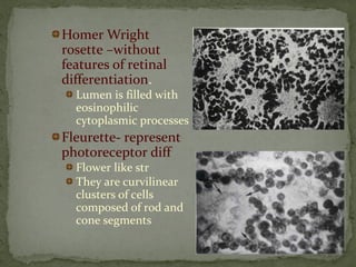 Homer Wright
rosette –without
features of retinal
differentiation.
Lumen is filled with
eosinophilic
cytoplasmic processes
Fleurette- represent
photoreceptor diff
Flower like str
They are curvilinear
clusters of cells
composed of rod and
cone segments
 