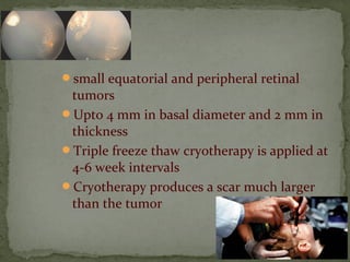 small equatorial and peripheral retinal
tumors
Upto 4 mm in basal diameter and 2 mm in
thickness
Triple freeze thaw cryotherapy is applied at
4-6 week intervals
Cryotherapy produces a scar much larger
than the tumor
 