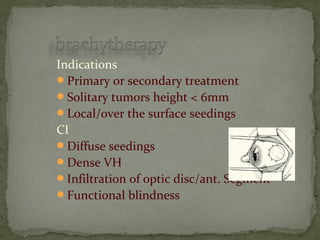 Indications
Primary or secondary treatment
Solitary tumors height < 6mm
Local/over the surface seedings
CI
Diffuse seedings
Dense VH
Infiltration of optic disc/ant. Segment
Functional blindness
 