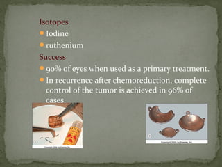 Isotopes
Iodine
ruthenium
Success
90% of eyes when used as a primary treatment.
In recurrence after chemoreduction, complete
control of the tumor is achieved in 96% of
cases.
 