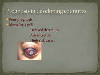 Poor prognosis
Mortality >50%
Delayed detection
Advanced dz
High risk cases
 