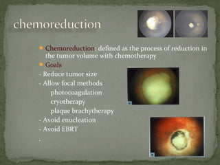 Chemoreduction: defined as the process of reduction in
the tumor volume with chemotherapy
Goals
- Reduce tumor size
- Allow focal methods
photocoagulation
cryotherapy
plaque brachytherapy
- Avoid enucleation
- Avoid EBRT
.
 
