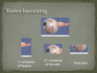 1st
container
of fixative
2nd
container
of formalin Petri dish
 