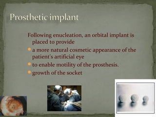 Following enucleation, an orbital implant is
placed to provide
a more natural cosmetic appearance of the
patient's artificial eye
to enable motility of the prosthesis.
growth of the socket
 