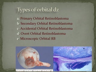 a. Primary Orbital Retinoblastoma
b. Secondary Orbital Retinoblastoma
c. Accidental Orbital Retinoblastoma
d. Overt Orbital Retinoblastoma
e. Microscopic Orbital RB
 