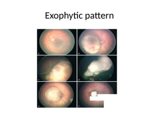 RETINOBLASTOMA prresentation.pptx endophytic and exophytic ...