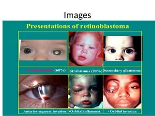 RETINOBLASTOMA prresentation.pptx endophytic and exophytic ...