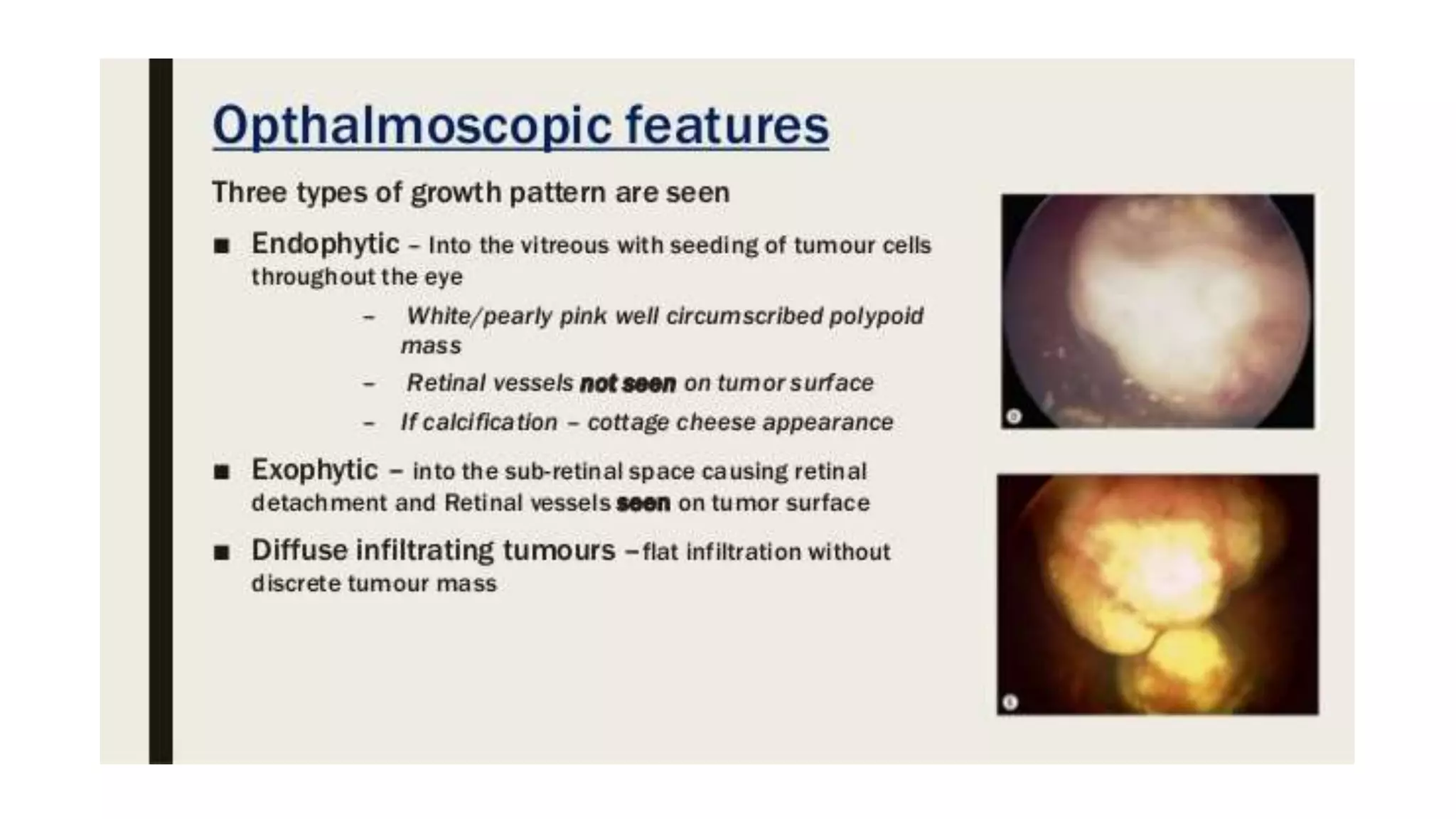 Retinoblastoma | PPTX