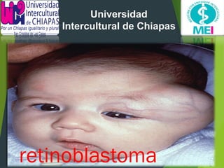 retinoblastoma
Universidad
Intercultural de Chiapas
 