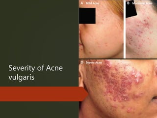 Severity of Acne
vulgaris
 