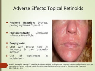 Adverse Effects: Topical Retinoids
 Retinoid Reaction: Dryness,
peeling erythema & pruritus
 Photosensitivity: Decreased
tolerance to sunlight
 Prophylaxis:
a) Start with lowest dose &
frequency & then gradually
increase
b) Use of sunscreens &
moisturisers
Khalil S, Bardawil T, Stephan C, Darwiche N, Abbas O, Kibbi A et al. Retinoids: a journey from the molecular structures and
mechanisms of action to clinical uses in dermatology and adverse effects. Journal of Dermatological Treatment.
2017;28(8):684-696.
 