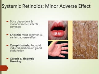 Systemic Retinoids: Minor Adverse Effect
 Dose dependent &
mucocutaneous effects
common
 Cheilitis: Most common &
earliest adverse effect
 Xerophthalmia: Retinoid
induced meibomian gland
dysfunction
 Xerosis & fingertip
fissuring
 