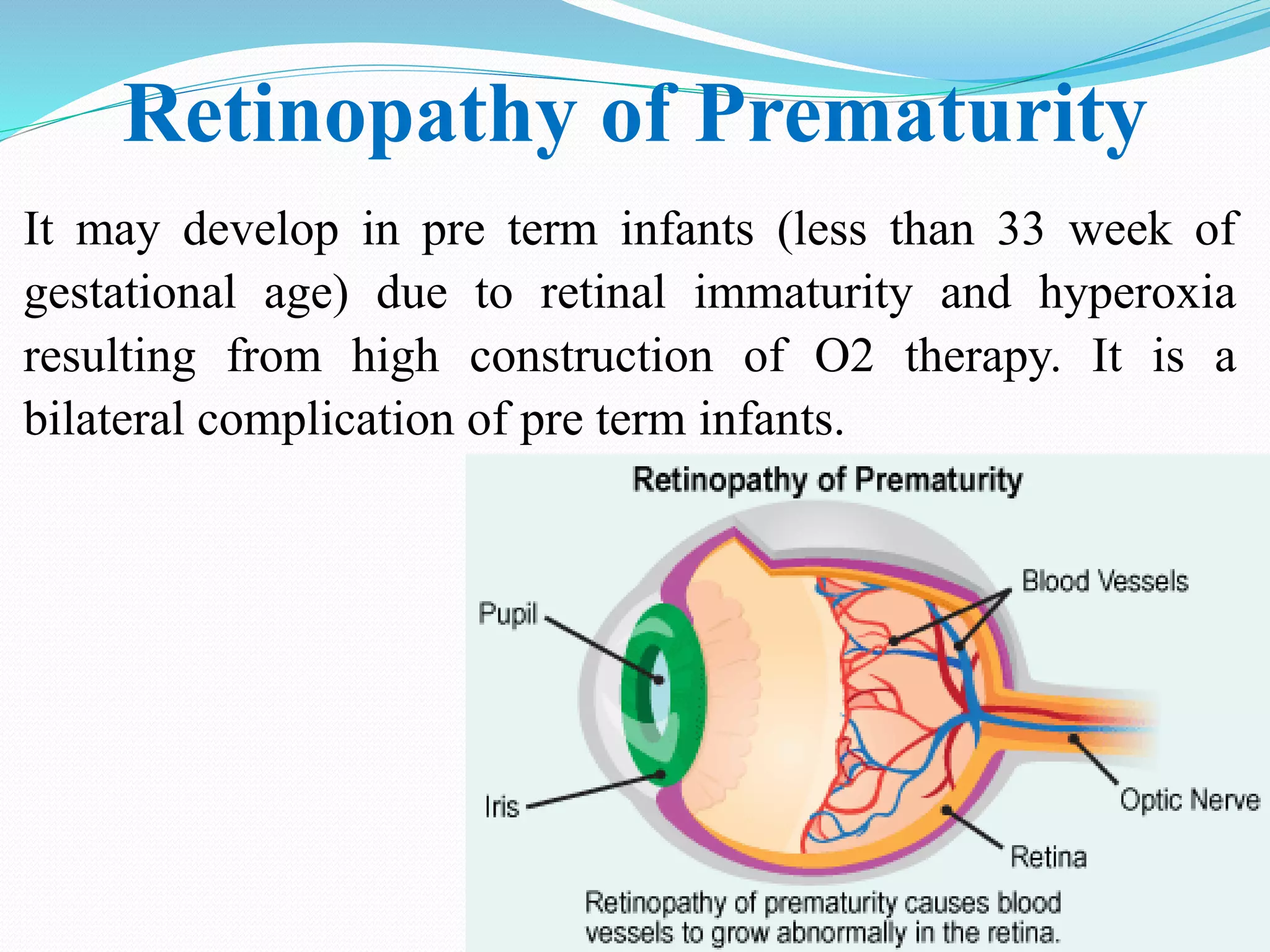 Retinopathy of Prematurity | PDF