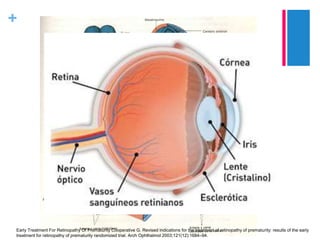Retinopatía del prematuro