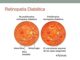 Retinopatía Diabética
 