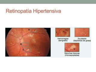 Retinopatía Hipertensiva
 