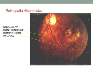 Retinopatía Hipertensiva



CRUCES AV
CON SIGNOS DE
COMPRESION
VENOSA
 
