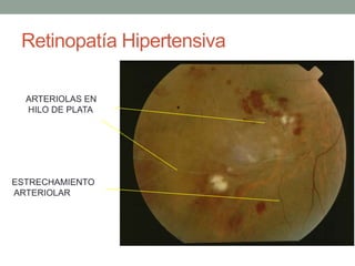 Retinopatía Hipertensiva

  ARTERIOLAS EN
  HILO DE PLATA




ESTRECHAMIENTO
ARTERIOLAR
 