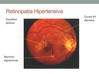 Retinopatía Hipertensiva
                            Cruces AV
 Exudados                   alterados
 lipidicos




Manchas
algodonosas
 