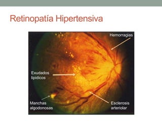Retinopatía Hipertensiva
                           Hemorragias




     Exudados
     lipidicos




     Manchas               Esclerosis
     algodonosas           arteriolar
 