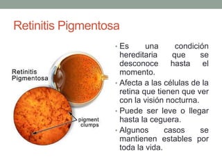 Retinitis Pigmentosa
                   • Es      una      condición
                     hereditaria     que     se
                     desconoce       hasta    el
                     momento.
                   • Afecta a las células de la
                     retina que tienen que ver
                     con la visión nocturna.
                   • Puede ser leve o llegar
                     hasta la ceguera.
                   • Algunos       casos     se
                     mantienen estables por
                     toda la vida.
 
