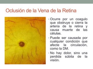Oclusión de la Vena de la Retina
                   • Ocurre por un coagulo
                     que obstruye o cierra la
                     arteria de la retina y
                     causa muerte de las
                     células.
                   • Puede ser causada por
                     cualquier condición que
                     afecte la circulación,
                     como la DM.
                   • No hay dolor, sino una
                     perdida súbita de la
                     visión.
 