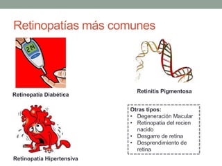 Retinopatías más comunes




                             Retinitis Pigmentosa
Retinopatía Diabética

                           Otras tipos:
                           • Degeneración Macular
                           • Retinopatia del recien
                             nacido
                           • Desgarre de retina
                           • Desprendimiento de
                             retina
Retinopatía Hipertensiva
 