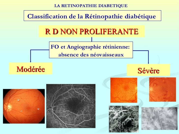 Retinopathie Diabetique 5ème - 