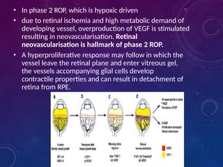 retinopathyofprematurity-17020tfgffhh6032912.pptx