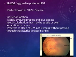 Agressive Rop retinopathyofprematurity-17020tfgffhh6032912.pptx