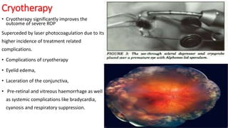 Retinopathy of prematurity | PPTX