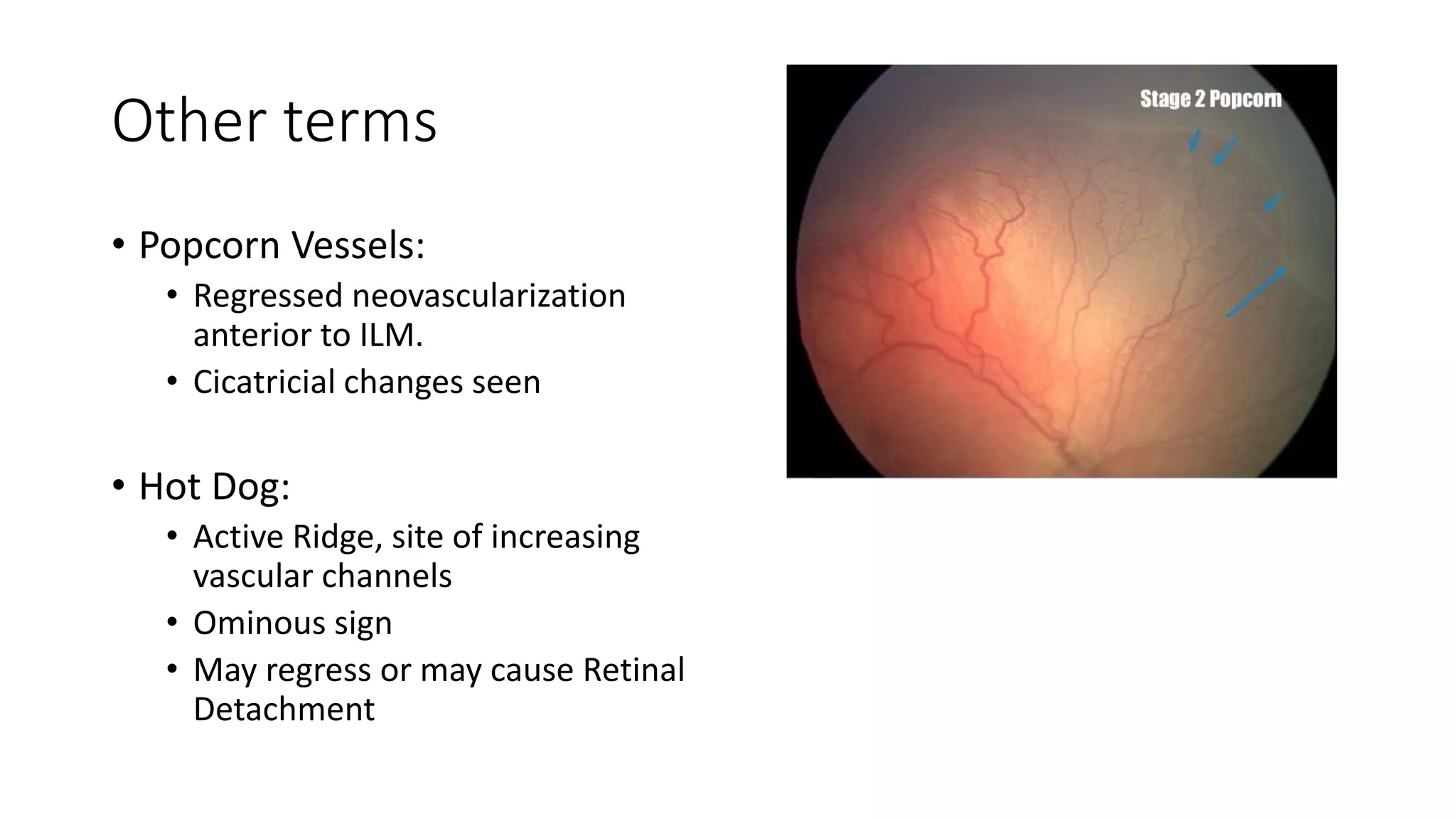 Retinopathy of prematurity | PPT