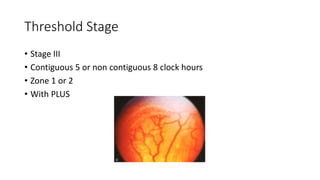 Retinopathy of prematurity | PPTX